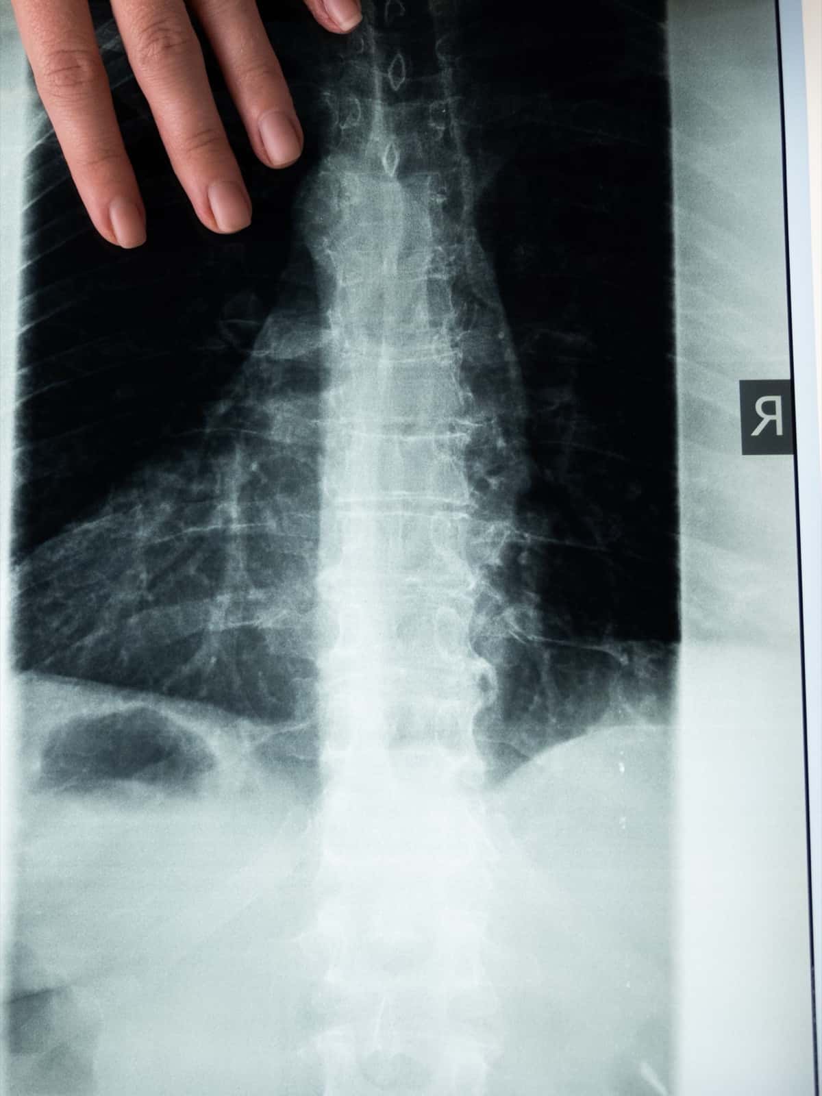 A hand resting on a backlit spine X-ray, the vertebral column running down the center of the film with the lumbar spine in the lower half.
