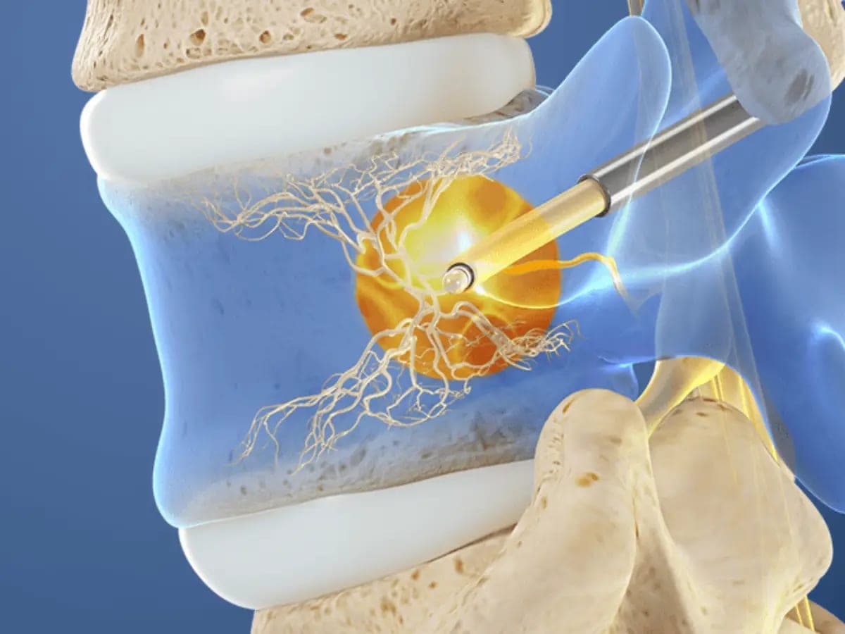 Illustration of a probe reaching the basivertebral nerve inside a vertebral body