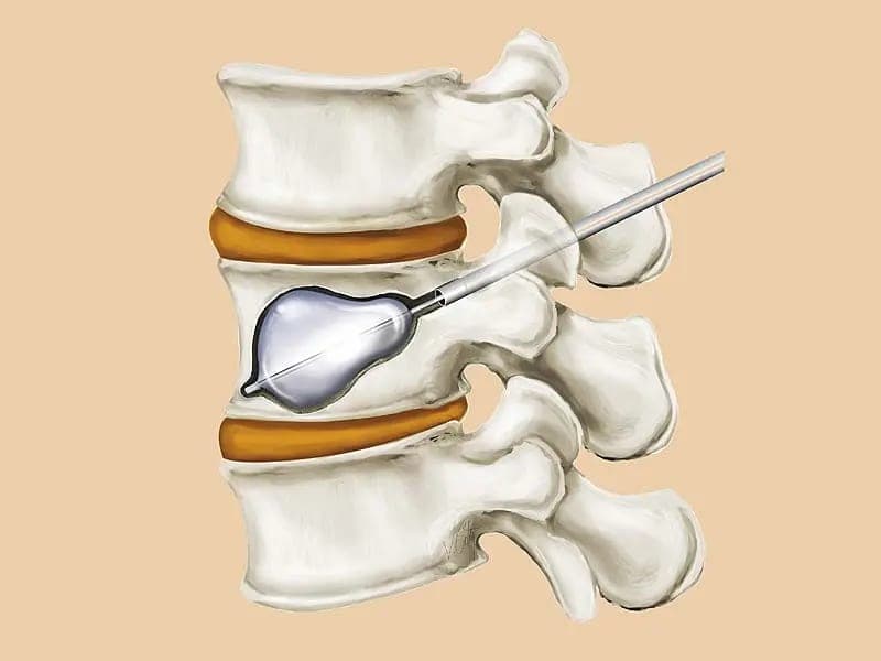 Illustration of a kyphoplasty balloon expanding a collapsed vertebra