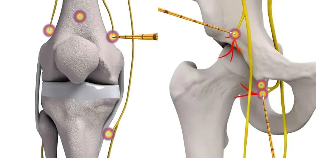 Illustration of radiofrequency probes targeting the nerves around a knee and a hip