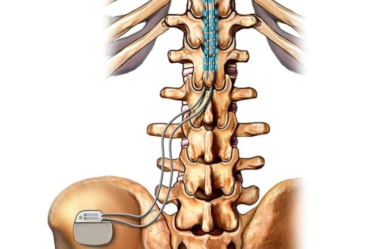 Illustration of spinal cord stimulator leads and pulse generator along the lower spine