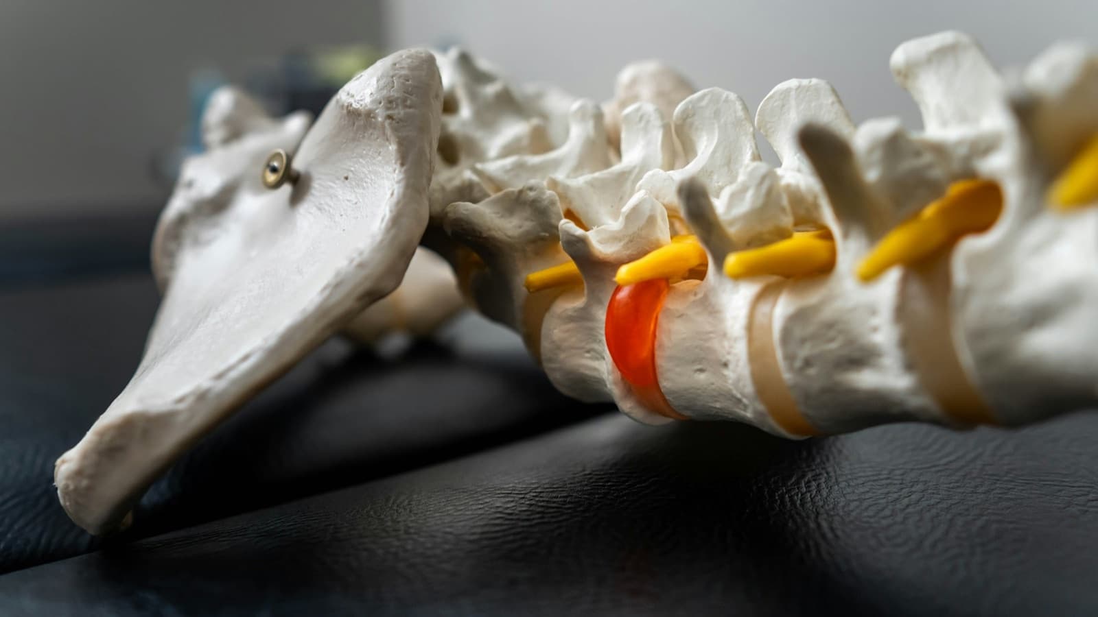 Close-up of an anatomical lumbar spine model with sacrum, yellow nerve roots, and a red herniated disc resting on a black treatment table.
